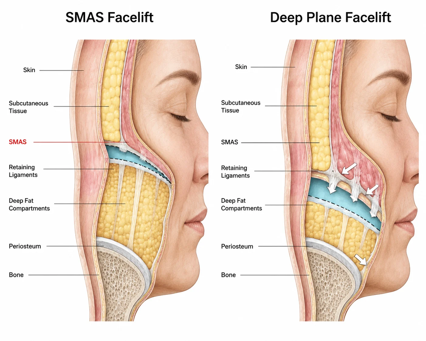 Deep Plane vs SMAS Facelift Comparison